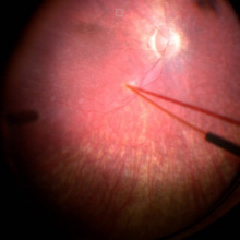 Moment podawania leku pod siatkówkę podczas operacji witrektomii